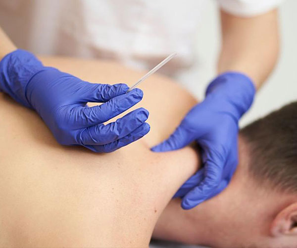 Le Kab - Dry Needling